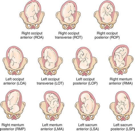 Optimizing Baby Position in Preparation for Birth