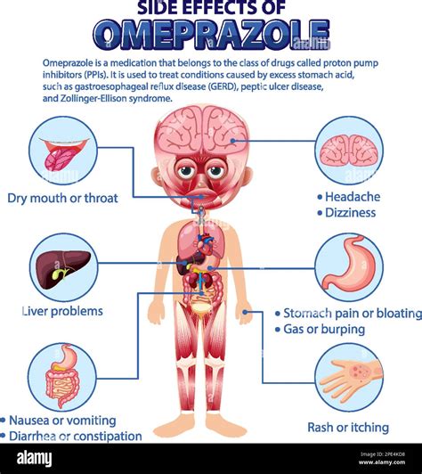 Human anatomy diagram cartoon style of Omeprazole side effects illustration Stock Vector Image ...