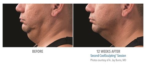 Double Chin Reduction Atlanta- CoolSculpting Chin - Sculpted Contours