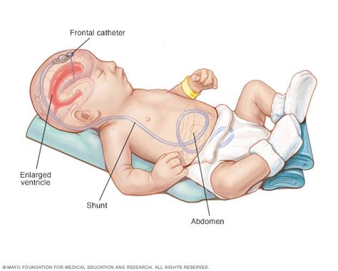 뇌수종(Hydrocephalus). 진단과 치료 : 네이버 블로그