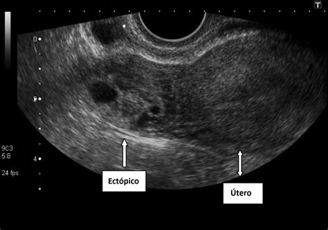 Embarazo ectópico: Causas, síntomas y tratamientos | Maternidadfacil