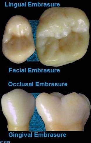 Embrasure | Dental anatomy, Dentistry, Dental