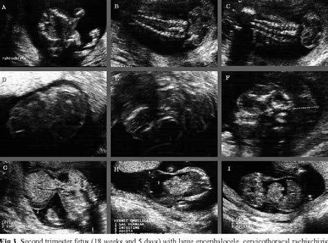 Figure 8 from Prenatal ultrasound diagnosis of neural tube defects ...