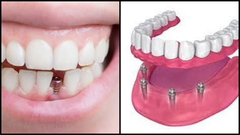 The Health Benefits of Getting Dental Implants Near Me - Career-Jobs4u