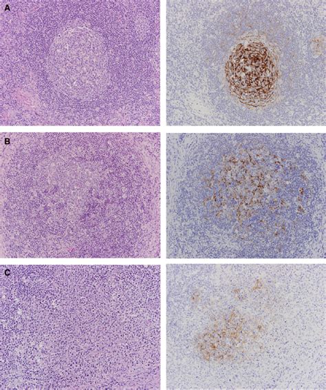 Germinal centres with corresponding patterns of follicular dendritic... | Download Scientific ...