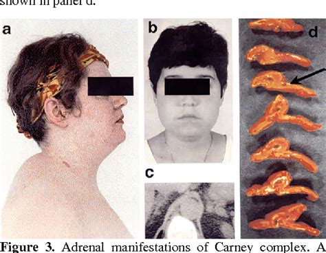 Figure 3 from Genetics of Carney complex and related familial lentiginoses, and other multiple ...