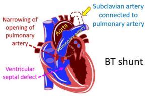 What is Blalock – Taussig (BT shunt) operation? – All About Heart And Blood Vessels