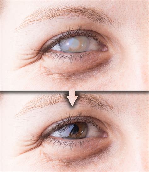 Is Blindness Due to Cataracts Possible? - ADV Vision Centers