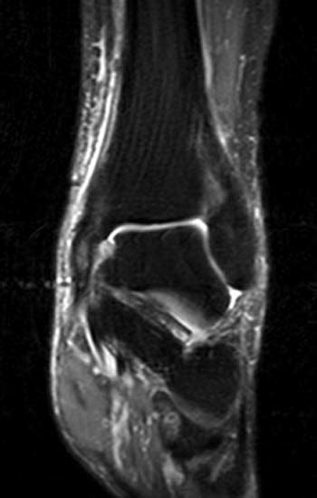 Posterior Tibial Tendinopathy - Radsource