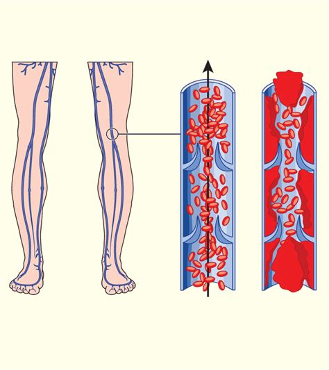 7 Most Common Causes Of Blood Clot During Pregnancy