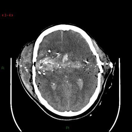 Traumatic brain injury | Radiology Reference Article | Radiopaedia.org