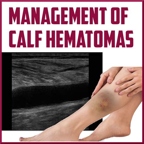 Management of Calf Hematomas - Sports Medicine Review