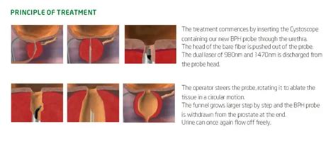 Male Urology Treatment For Benign Prostate Enlargement With Laser - Buy Bph Laser For Enlarge ...