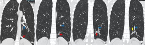 Computed Tomography Pulmonary Angiogram revealing an intralobar... | Download Scientific Diagram