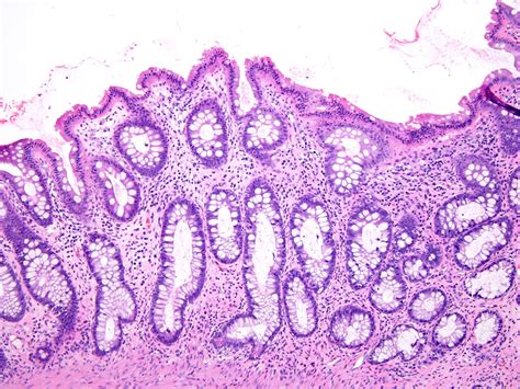 Histology Of Ulcerative Colitis