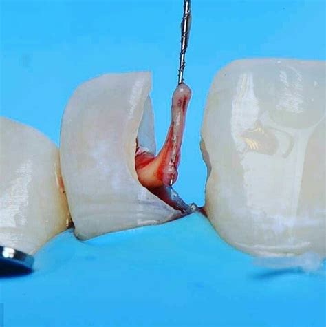 This is how the tooth nerve looks (dental pulp). | Dental implants cost ...