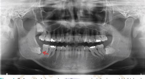 Figure 1 from The incidence of Oro-maxillofacial lesions ( 10 years ...