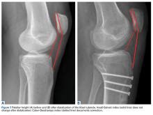 Patella Alta: A Comprehensive Review of Current Knowledge | MDedge Surgery