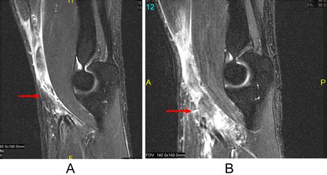 Biceps Tendon Mri Elbow