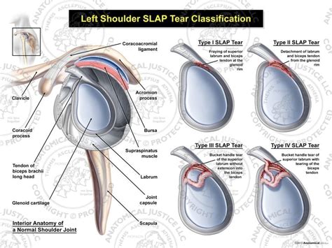 Left SLAP Tear Classification