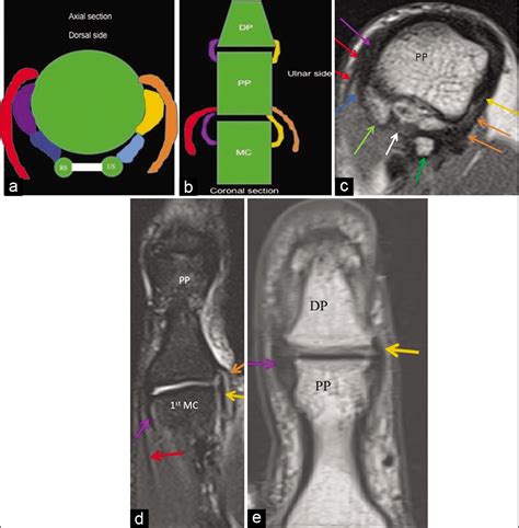 3T Magnetic Resonance Imaging of the Thumb-normal Appearances and Common Injuries - Indian ...