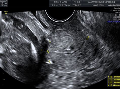 Endoscopic transabdominal cervical cerclage replacement after recurrent late miscarriage | BMJ ...