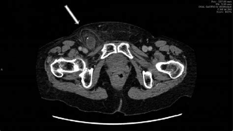 This image demonstrates an abdominal computed tomography (CT) scan with... | Download Scientific ...