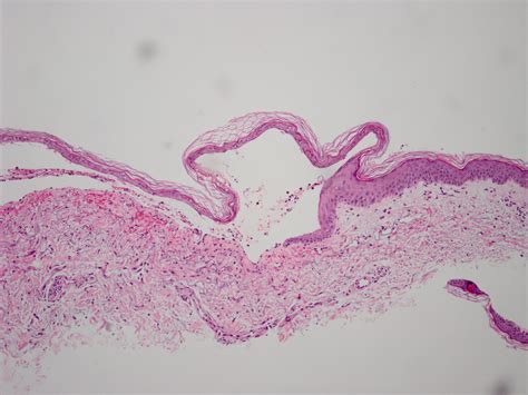 Porphyria cutanea tarda (acquired porphyria, sporadic porphyria ...