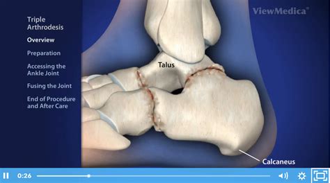 Triple Arthrodesis Surgery | Scottsdale - Foot & Ankle Center of Arizona