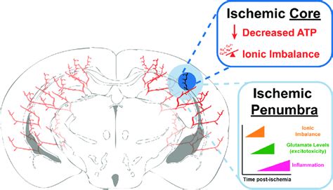 Ischemic Stroke. Schematic diagram of an ischemic stroke in a coronal ...