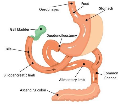 Duodenal Switch Surgery Side-Effects & Vitamins