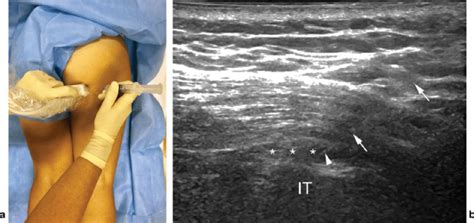 Ischial bursitis injection. (a) Simulation of probe and needle... | Download Scientific Diagram