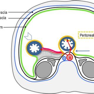 The perirenal space. Axial contrast-enhanced CT scan (A-C), show the... | Download Scientific ...