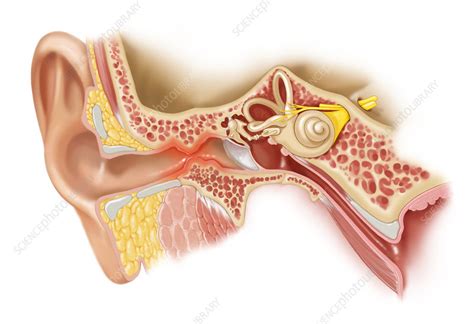 Surfer's Ear, Illustration - Stock Image - C050/1337 - Science Photo ...