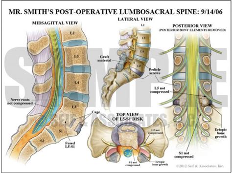 Lumbar Nerve Root Case Study - S&A Medical Graphics