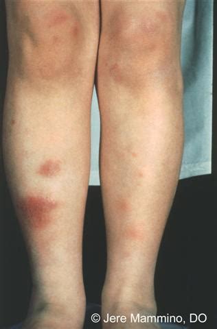 Erythema Nodosum - American Osteopathic College of Dermatology (AOCD)