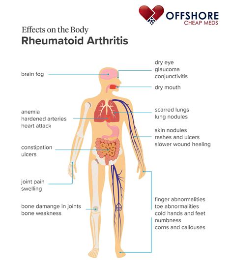 What Are The Complications Of Rheumatoid Arthritis?