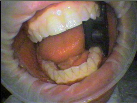 Need a Mouth Prop? Part 1 – Bite Block | Seymour Dental - Dedicated personal care