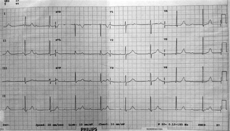 ECG showing congenital heart block | Download Scientific Diagram