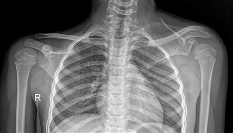 Sprengel deformity | Radiology Case | Radiopaedia.org | Radiology ...