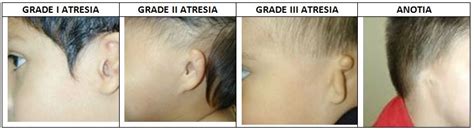 Supporting Success For Children With Hearing Loss | Atresia, Microtia ...