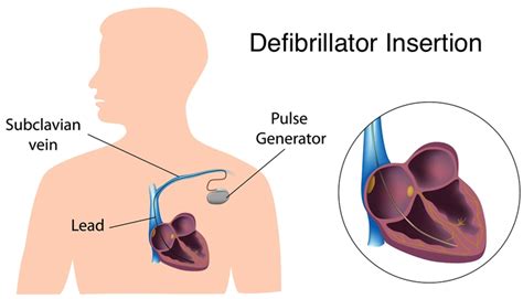 Automated implantable cardioverter defibrillator (AICD) | Learn the Heart