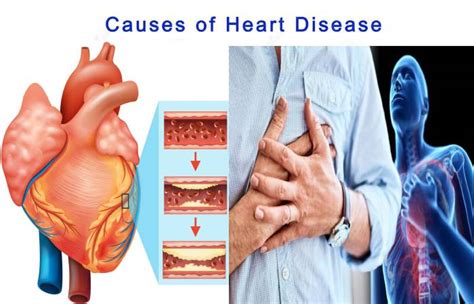 Heart Disease – Definition, Symptoms, Causes, Risk Factors, and More