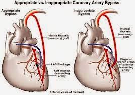 Medical Treatment Pictures-for Better Understanding: Triple Bypass ...