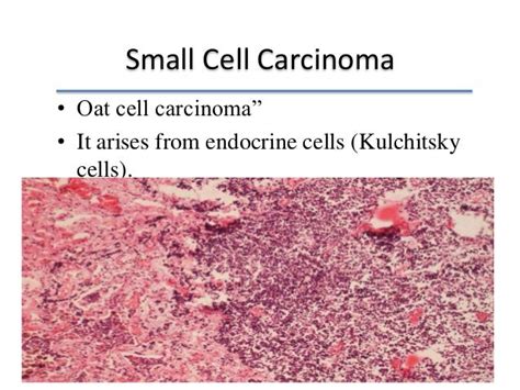 Lung cancer