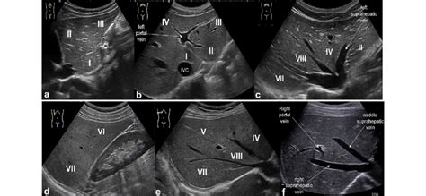 US study of the liver: longitudinal and transverse scan along the ...