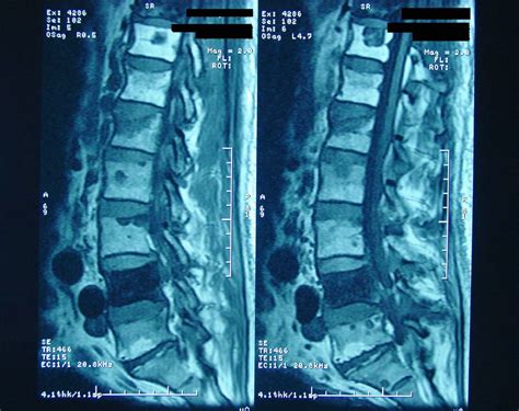 CasesBlog - Medical and Health Blog: Prostate Cancer with Bone Metastases and PSA of 900 ng/mL