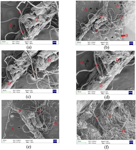 The potential role of neutrophil extracellular traps (NETS) in ...