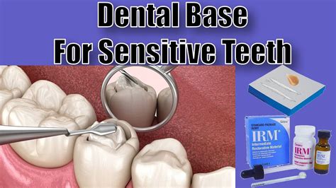 Dental Bases - Mixing and Placement - Dental Assisting 101 - YouTube