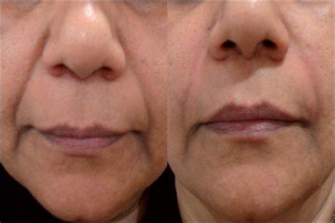 Removing Laugh Wrinkles And Nasal Furrows With Facial Toning Massage | Facial toning, Facial ...